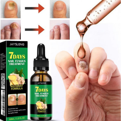 TRATAMIENTO 7 DÍAS PARA HONGOS EN UÑAS – PIES Y MANOS (30 ML)